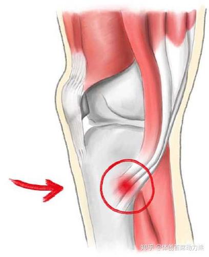 跑步后一周后膝盖内侧疼,刚开始感觉没那么疼,一周左右没有去运动反而