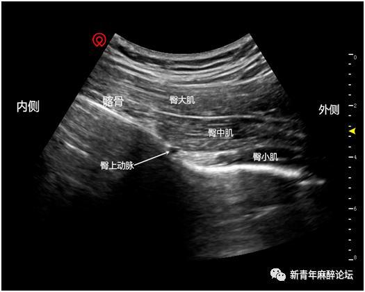 超声联合神经刺激仪双重引导"领结征"髂筋膜阻滞联合骶丛阻滞
