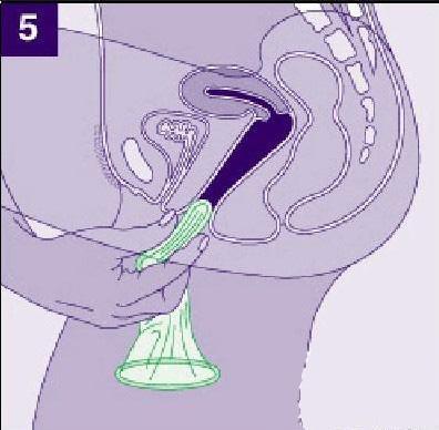 女用避孕套演示图