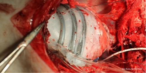 美国发明新型环抱心脏起搏器