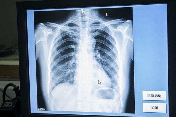 胸透 女性不愿意做胸透