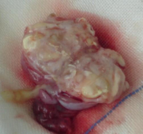 小儿右侧睾丸肿瘤一例