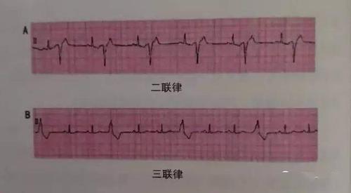 认识早搏和心房颤动(2)——关于早搏,二联律,三联律和短阵室性心动过