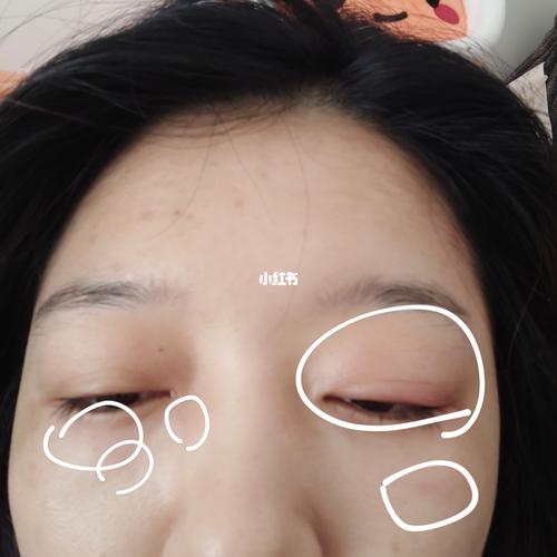 求助,为什么早上醒来眼睛肿成这样_过敏_双眼皮_口罩