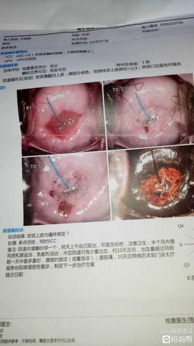 26岁hpv感染,糜烂医生建议手术,看着