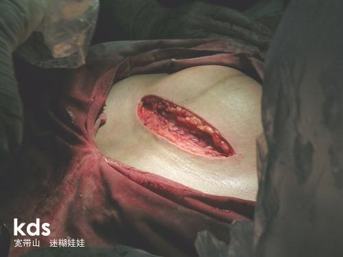 顺产破腹产全过程,男人们请珍惜为你生孩子的那个女人