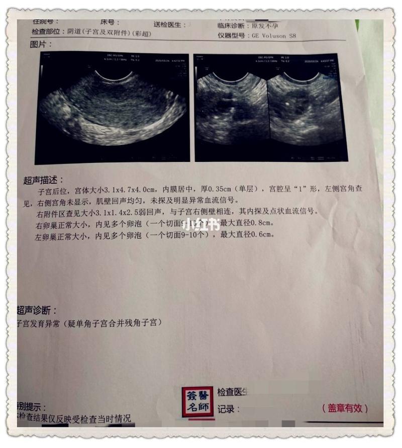 单角子宫合并残角子宫致不孕,求子无望了?