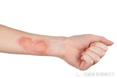 体育与健康水平三3轻度损伤的自我处理