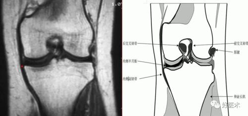 横韧带连接内外侧半月板前角,呈现低信号索带样结构 .
