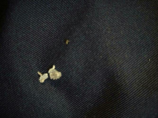 耳朵里面脱皮 不是耳屎吧