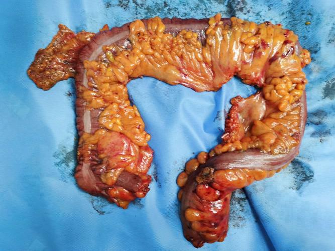 03.24首例腹腔镜下全结肠切除 乙状结肠癌根治术