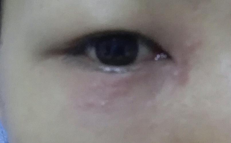 很痒,不知道什么原因,看医生说过敏,一百多的眼药水,吃药和滴眼药水都