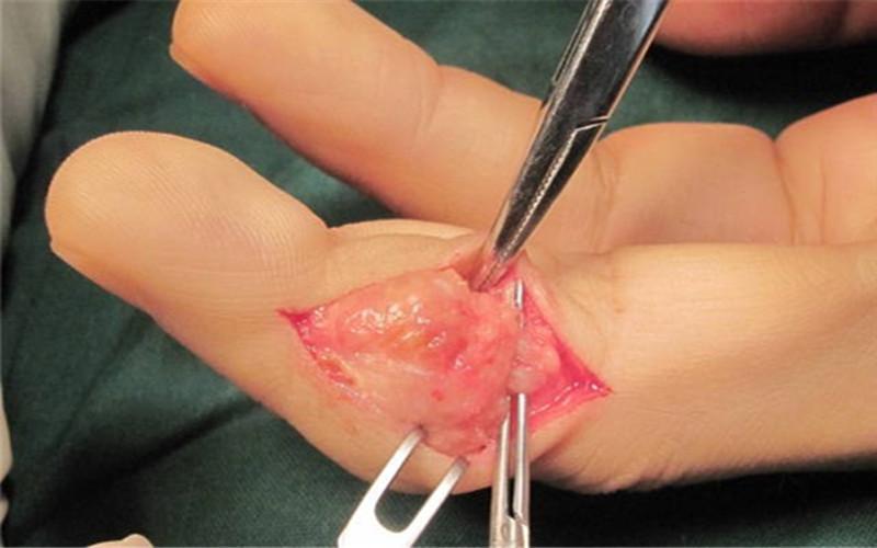 左手手指腱鞘囊肿手术图片