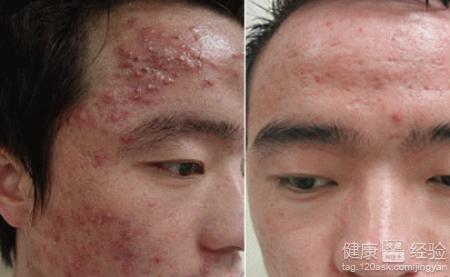 正文  人到青春期的时候,脸上最容易长有痘痘,这被称之为青春痘,虽然