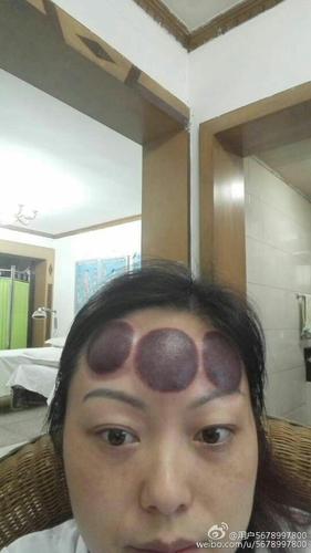 看图说话一脑门拔罐