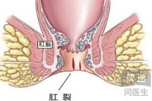 由于这个溃疡面,就算肛裂