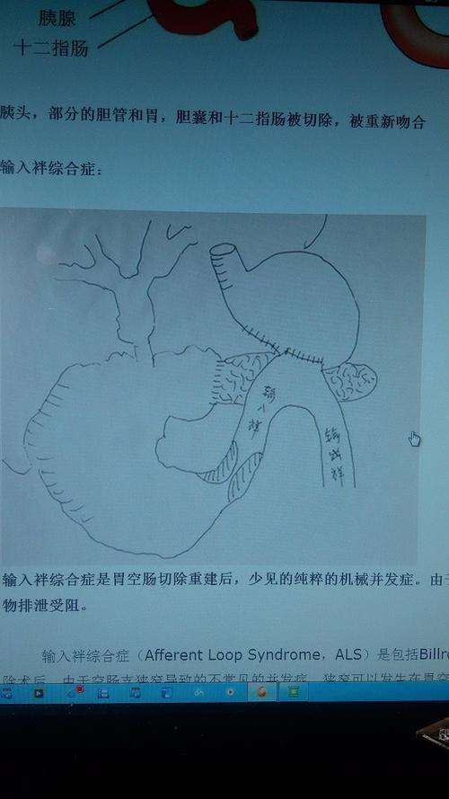 胃胰腺胆管疾病术后腹痛发热黄疸警惕输入袢综合征