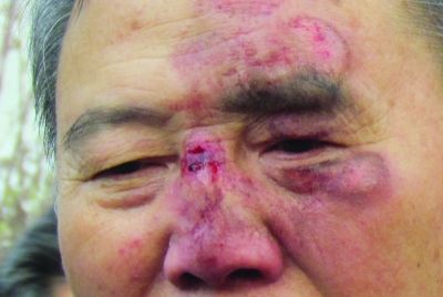 南京路面隔离桩损坏残留螺钉 路人被绊摔得鼻青脸肿
