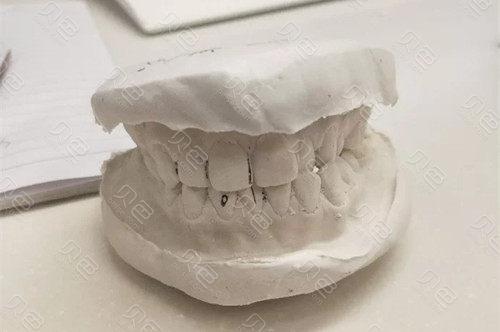 牙齿咬合问题导致脸歪必须进行矫正