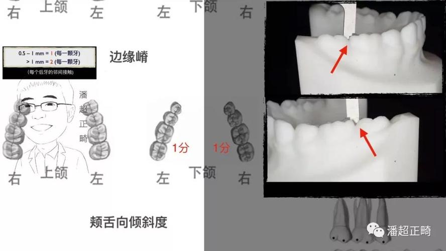 缺一颗侧切牙,中线不齐,前突,拔牙矫正