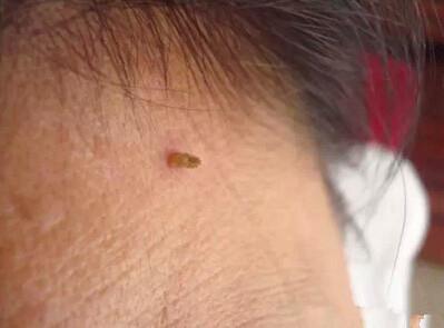 脖子和腋下的小肉粒是什么可以用手直接揪掉吗涨知识了