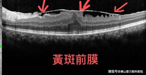 术前的黄斑oct
