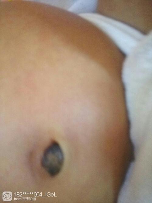 宝宝都一个多月了,肚脐眼儿还没长好,怎么办啊