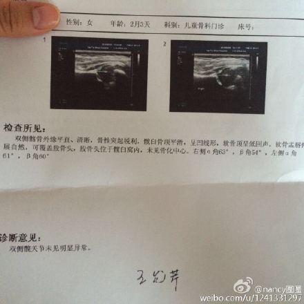 我家女宝四个月了,42天体检时大腿纹不对称,b超显示右腿角度异常,两个