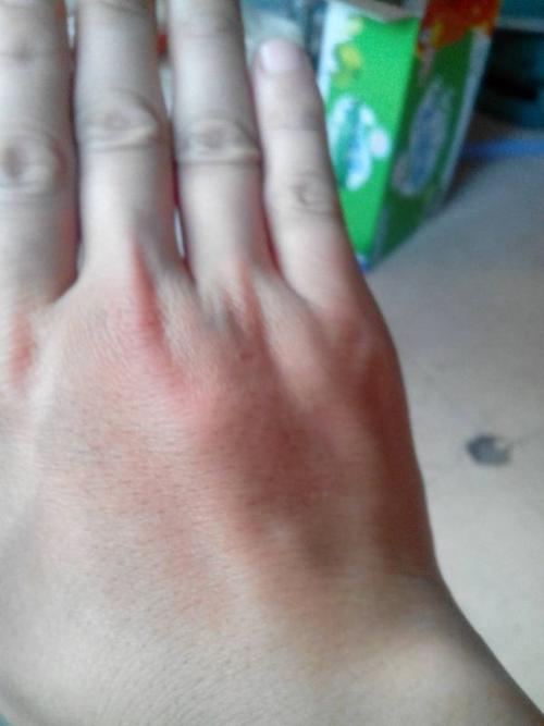 手背上肉内鼓了个包,按着疼