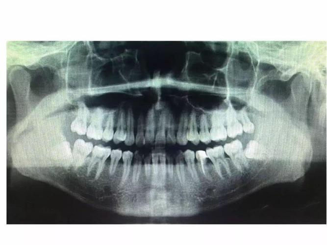 智齿牙骨质增生,可以引起牙根肥大,拔的越晚,可能越不好拔.  2. 毁容!