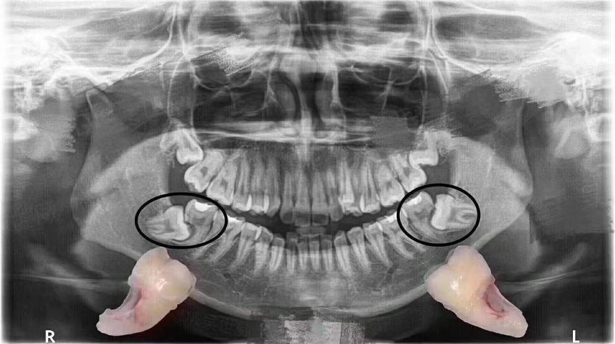 牙齿的牙根是埋在牙槽骨中的 医生没有透视眼 为了解患牙的牙根的