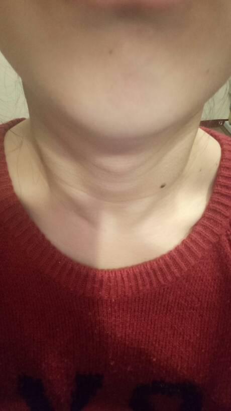 我是16岁高中女生,可是脖子上有喉结有点突出,同学们也曾经笑过我,我