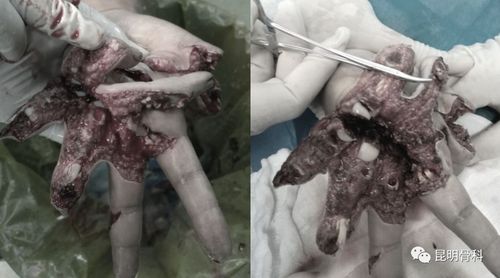 男子左手濒临截肢,昆明骨科成功保肢