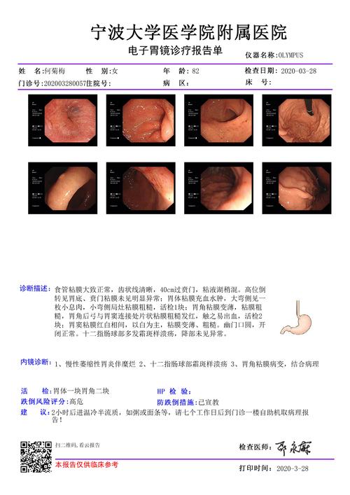 胃角细胞异型,黏膜内腺体癌变?