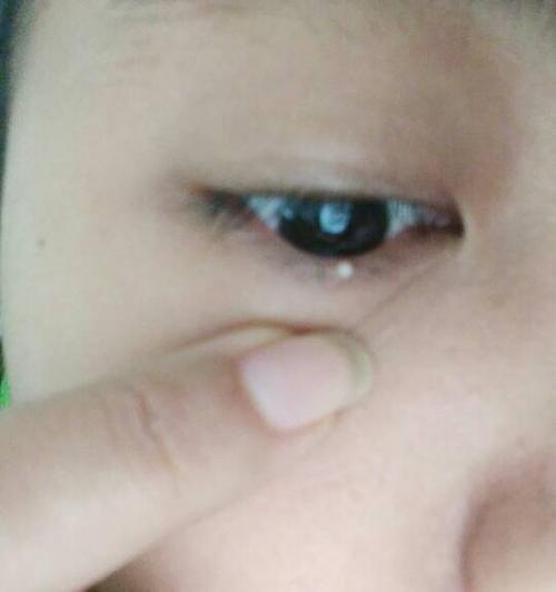 内眼线,睫毛根部的地方长了一个白色的小疙瘩,不疼不痒,很硬,是怎么