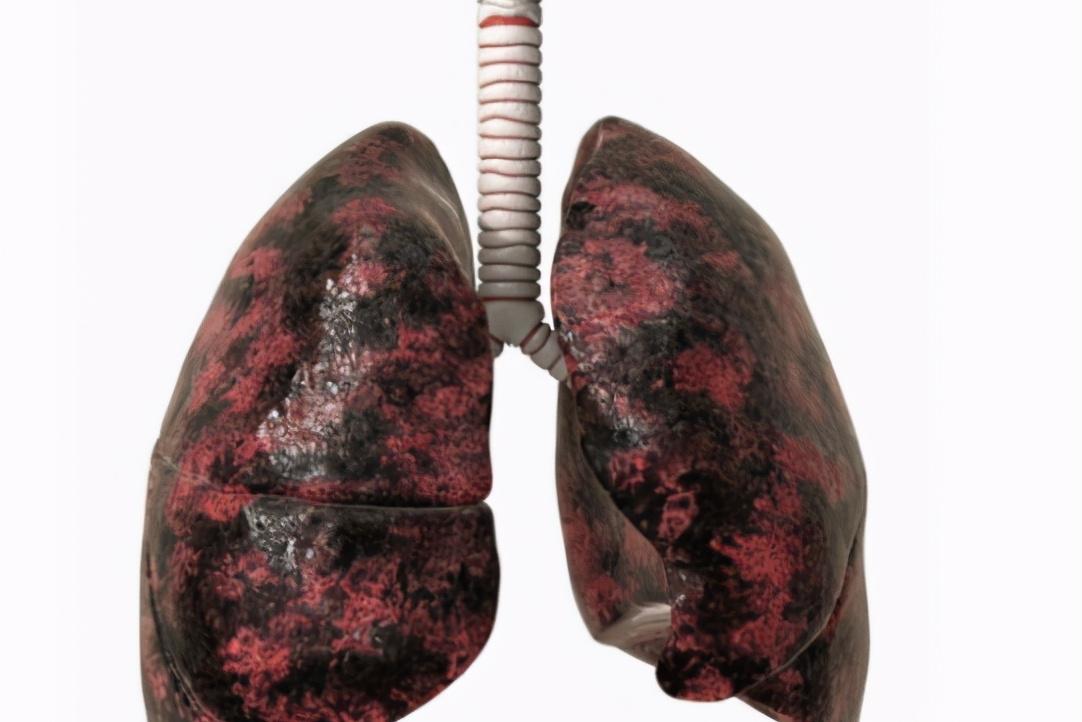 "烟毒"损伤肺部,外在会有4个表现,占了1个,也要尽早养肺