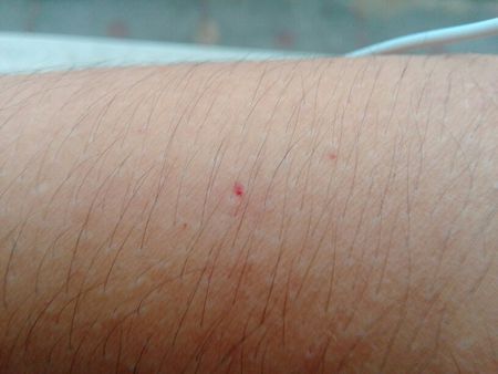 我发现自己身上的红点与其相似,并且我头晕,所以我怀疑自己得了白血病