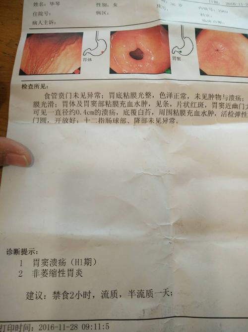 胃窦近幽门大湾则有约0.4溃疡,严重吗