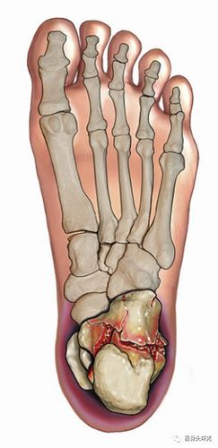 脚后跟痛?|| 小心犯了"跟痛症"