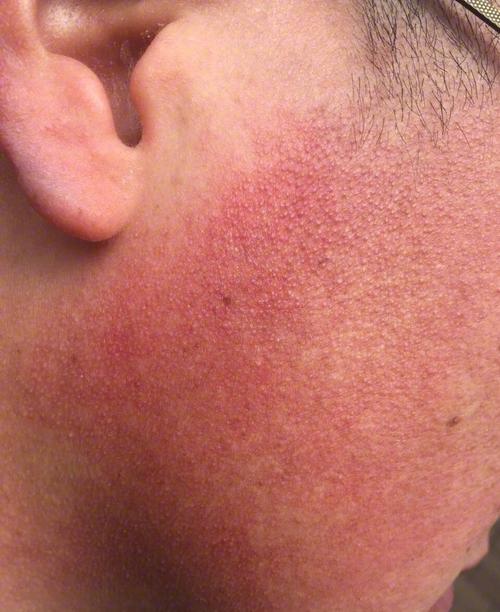 青春年代都已逝去,颜值再高还有什么意义啊)   在红斑角化的皮肤里面