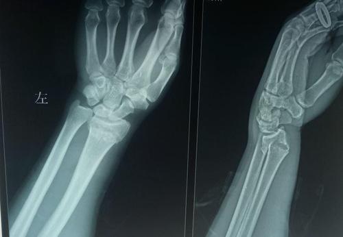 桡骨远端骨折
