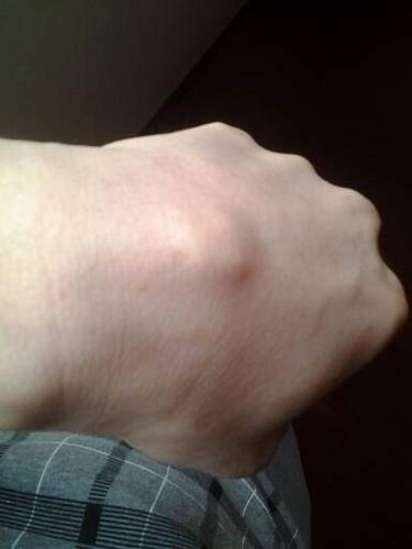 搜索手腕腱鞘炎囊肿看什么科,要怎么医治?