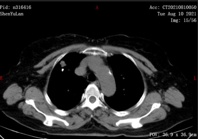 重庆市第五人民医院:面对癌症转移,射频消融术助患者