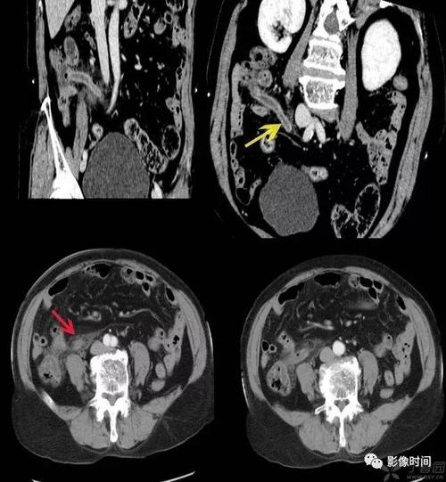打基础急性阑尾炎ct诊断