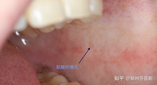 什么是口腔黏膜纤维化,看完还敢嚼槟榔吗?