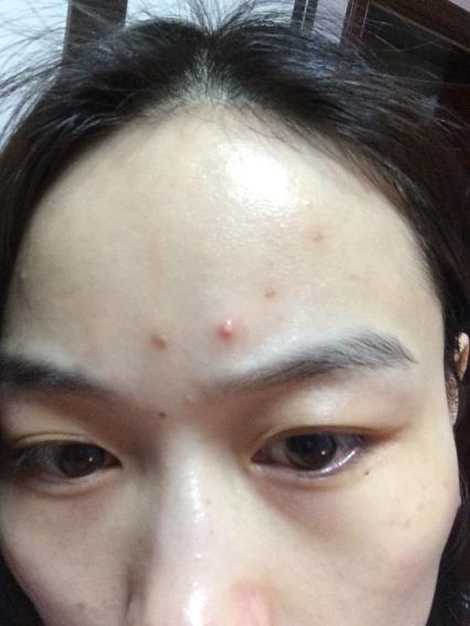 有人说青春痘?这是青春痘吗跟上一个问题的痘痘是一种类型的.