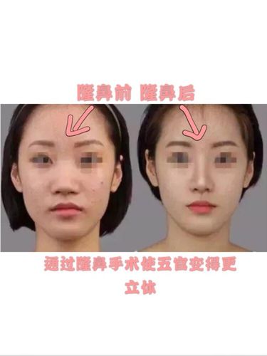 那么因为人的基因不同,鼻子背部呈现的曲线和高度也不同,许多人追求高