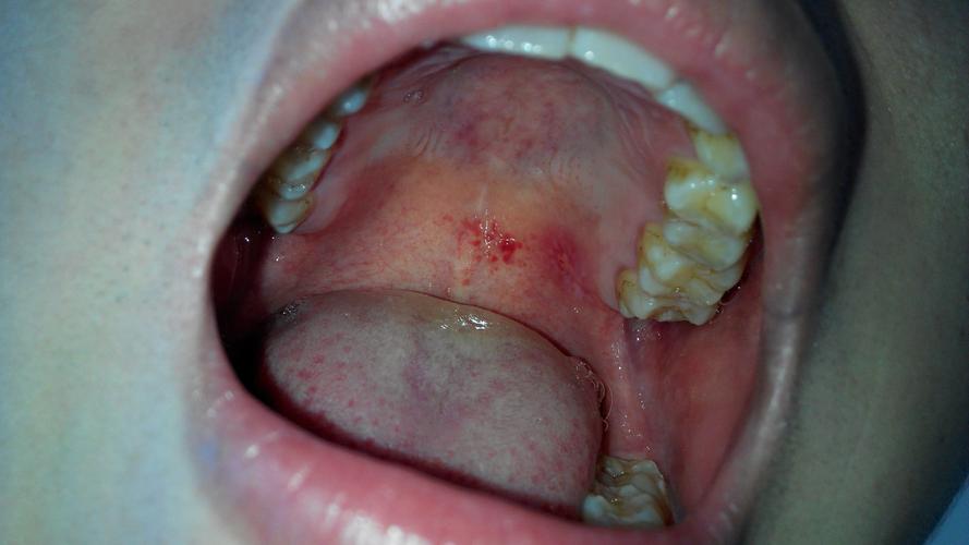 我口腔上面的红色区域,以及图片右侧牙齿根部的区域,是什么病状?