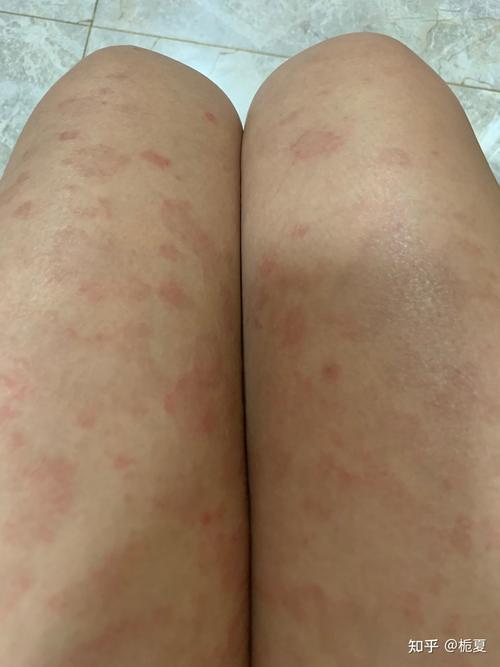 玫瑰糠疹两个多月了还没好