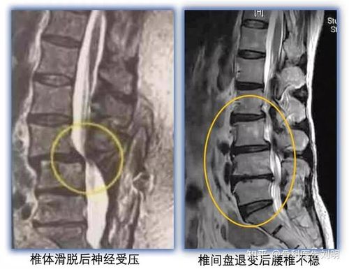 当腰椎发生退变,例如椎间盘突出,膨出后高度丢失,或是扭伤等导致椎间